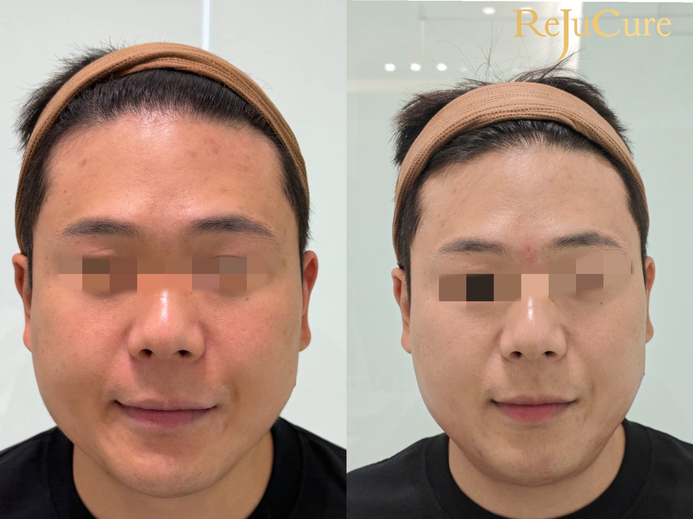 리쥬큐어 실제 치료 전후 정면 비교 사례 3